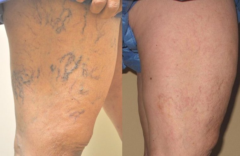 Spider Vein Treatment | Remove Unwanted Veins in Media, PA
