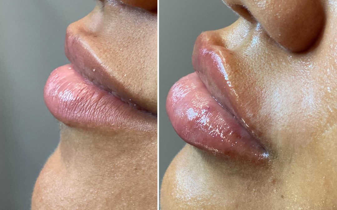 Beautiful luscious lips by Nurse Injector Michelle