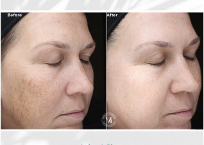VI Peel Advanced Before and After 1