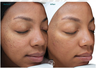 VI Peel Advanced Before and After 2