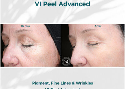VI Peel Advanced Before and After 4