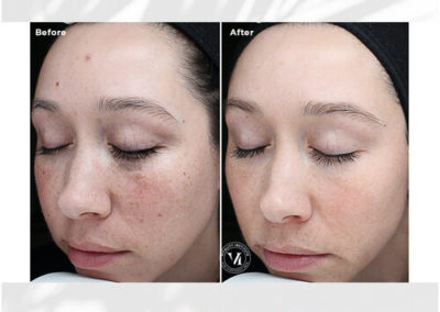 VI Peel Original Before and After 4