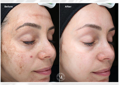 VI Peel Precision Plus Before and After 2
