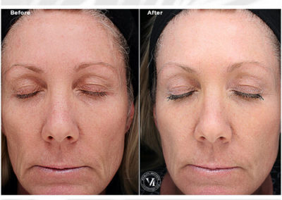 VI Peel Precision Plus Before and After 3