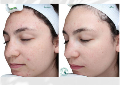 VI Peel Purify Before and After