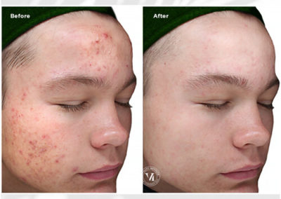 VI Peel Purify Before and After 2