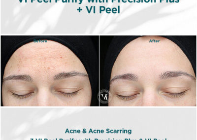 VI Peel Purify with Precision Plus Before and After 1