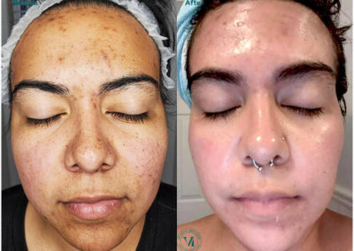 VI Peel Purify with Precision Plus Before and After 2