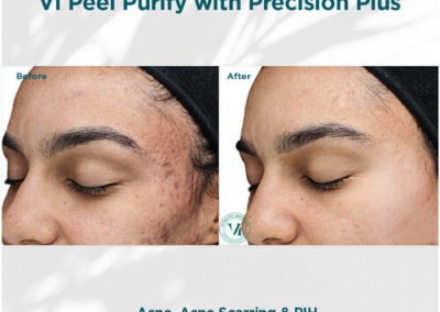 VI Peel Purify with Precision Plus Before and After 3